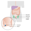 Stage 1 anal cancer