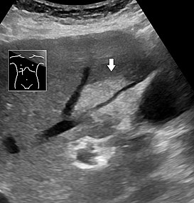 Abdominal ultrasonography of focal steatosis. It is distinguished from a tumor by not compressing the hepatic vein.