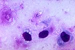 Pneumocystis carinii gây bệnh viêm phổi ở người