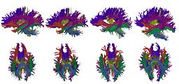 High-dimensional white matter atlas generation and group analysis: result of automatic segmentation of novel subjects.