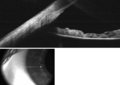 Anterior chamber angle cross-section imaged by an SD-OCT.