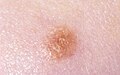 Spitz nevus