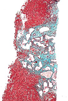 Low magnification micrograph of a bile duct hamartoma. Trichrome stain.