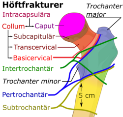 Höftfraktur-indelning.png