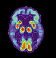 Tomografie cu Emisiune de Positroni-PET . Imagini caracteristice la un pacient cu boala Alzheimer.