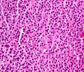 Plasmacytoma, H&E stain