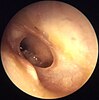 Otitis media crónica mesotimpánica