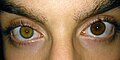 Heterocromia completa.