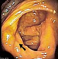 Immagine endoscopica del cieco, la freccia indica la valvola ileociecale