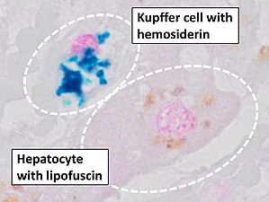 Prussian blue staining, highlighting the hemosiderin pigment as blue.