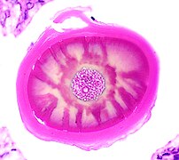 Histology of a multilayered corpus amylaceous of the prostate.