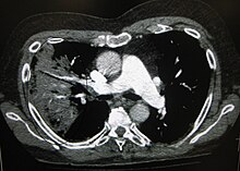A black and white image show the internal organs in cross section as generated by CT. Where one would expect black on the left one seen a whiter area with black sticks through it.