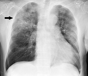 A Xray showing a white wedge in the right lung field of a chest X-ray.