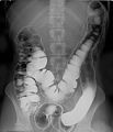 Double contrast barium enema - Using positive and negative contrast