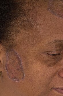 Violaceous, annular, scaly plaques on the face and scalp of an adult