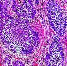 Nests: islands of cells of similar type.