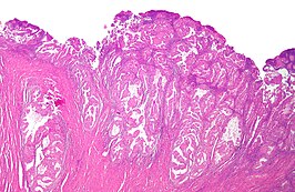 Histologisch preparaat van endometriaal adenocarcinoom, de meest voorkomende vorm van baarmoederkanker, gekleurd met hematoxyline en eosine.