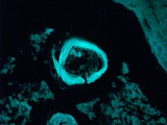 Natural luminescence of corpora amylacea in the lumen of the prostate in ultraviolet light