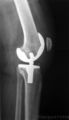 Radiographie d'une prothèse de genou (profil).