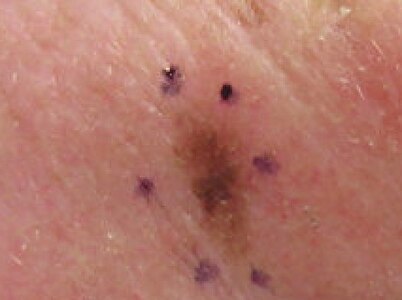 Lentigo Maligna Melanoma, Left Central Malar Cheek marked for biopsy