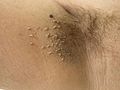 A. nigricans, right armpit; notice the skin tags,[10] an indicator for elevated blood sugar and hyperinsulinaemia
