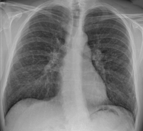 Keuhkoröntgenkuva, jossa nähdään sarkoidoosiin sopivaa solmukemaista kuviolisää keuhkoporttien alueella.