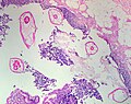 Os oxiúros son ás veces diagnosticados casualmente por outras patoloxías. Micrografía de oxiúros no apéndice vermiforme. Tinguidura de hematoxilina-eosina.