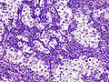 Histopathological image of metastatic seminoma in the inguinal lymph node. Hematoxylin & eosin stain.