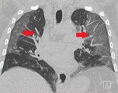 Radiografía (TAC) pulmonar dun caso de pneumonía por COVID-19