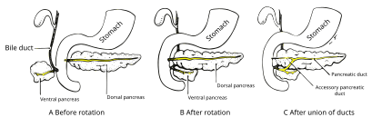 Formation of an accessory pancreatic duct