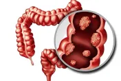 10年暴增3成！每10人就有7人有腸息肉　其中1成8「易癌化」