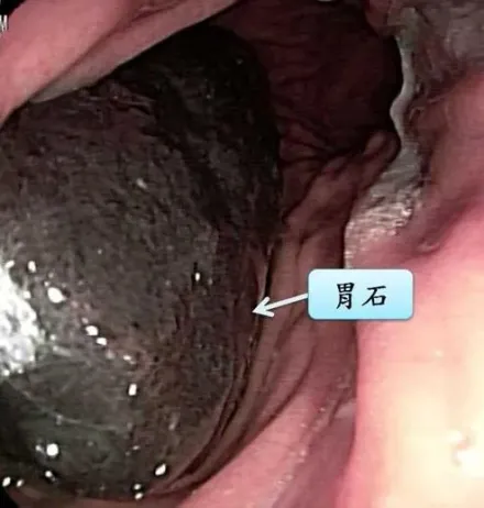 8旬老翁胃痛求診　照胃鏡驚見「5公分大黑石」！醫授：喝可樂軟化結石