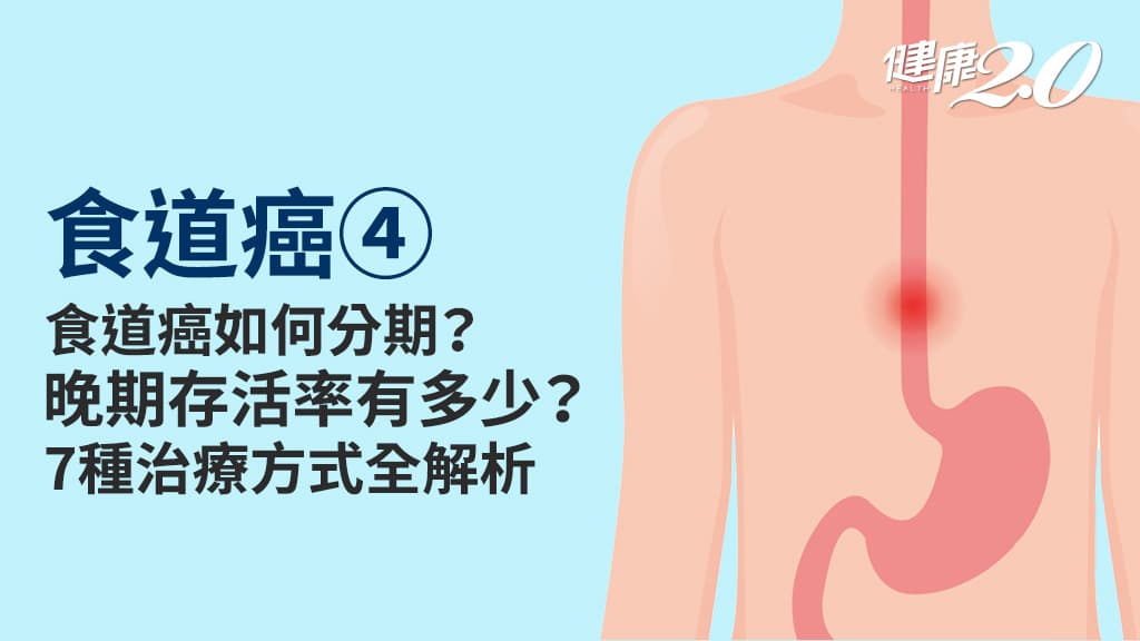 食道癌／食道癌可以活多久？治療方法有哪些？1療法臨床證實抗癌效果佳