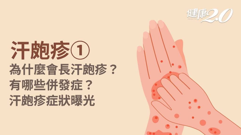 汗皰疹／汗皰疹原因有哪些？9大危險因子曝光！汗皰疹症狀一覽