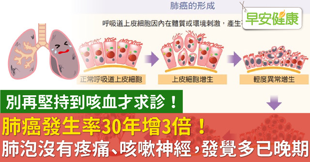 肺癌發生率30年增3倍！肺泡沒有疼痛、咳嗽神經，發覺多已晚期