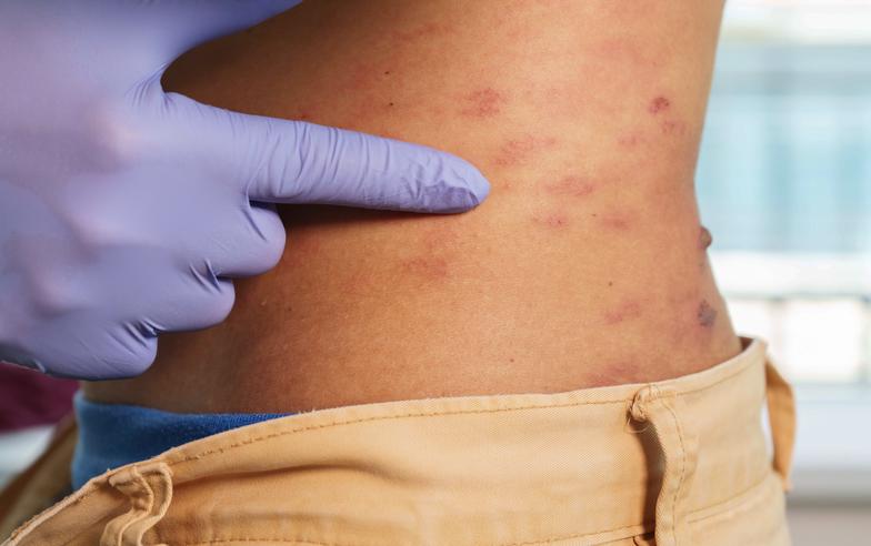 帶狀皰疹症狀有哪些？帶狀皰疹會傳染嗎？痛起來要人命的皮蛇Q&A