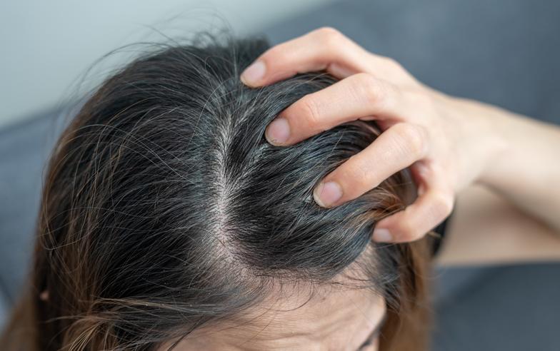 頭皮屑成因有哪些？免疫力失調小心頭皮屑變多！頭皮屑很多該怎麼改善？