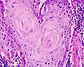 Carcinoma planoepitheliale keratodes laryngis (well differentiated)