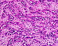 Carcinoma adenoides ventriculi (low differentiated)