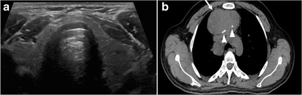 Fig. 4. A 45-year-old male patient presented with anterior mediastinal metastatic PTC lesions and occult primary on imaging. Histopathology examination of the resected thyroid gland revealed micro-foci of PTC; the largest, in the isthmus, measured 4 mm. a transverse greyscale ultrasound of the thyroid demonstrates homogeneous gland with normal echogenicity and size. No focal lesion or micro-calcifications. b Non-enhanced CT scan obtained as part of PET/CT examination shows a heterogeneous, large, relatively dense anterior mediastinal mass (white arrow) with peripheral calcification (arrowheads). Thyroid gland has normal CT appearance with no abnormal FDG uptake (not shown).[1]