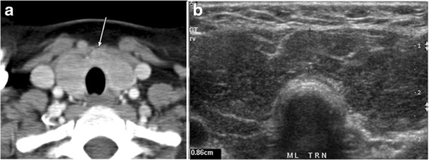 Fig. 15. A 33-year-old female patient who presented with neck swelling and pain and was later diagnosed with Hashimoto's thyroiditis. an Axial enhanced CT scan of the neck demonstrates minimal diffuse enlargement of the thyroid gland, especially the isthmus (white arrow). b Transverse greyscale ultrasound of the neck demonstrates heterogeneously enlarged thyroid and thickened isthmus, measuring 8.6 mm.[1]