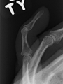 Un dedo en martillo sin una fractura asociada