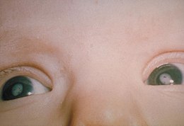 Description de l'image Cataracts due to Congenital Rubella Syndrome (CRS) PHIL 4284 lores.jpg.
