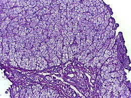 Description de l'image Glycogen storage disorder (PAS with diastase).jpg.