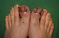 Ingrown toenail before Vandenbos procedure