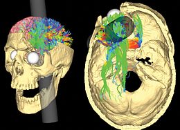 A diagram of Gage's skull