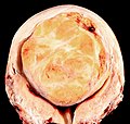 A relatively large submucosal leiomyoma; it fills out the major part of the endometrial cavity.