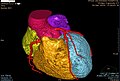 Hình 5: Ảnh chụp cắt lớp động mạch vành tim và tim người kết hợp dùng chất cản quang.