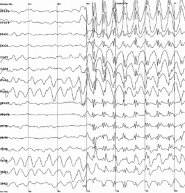 EEG-opname van gegeneraliseerde 3 Hz piek-en-golf-ontladingen gezien bij een kind tijdens een afwezigheidsaanval (absence)