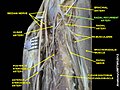 Radial recurrent artery